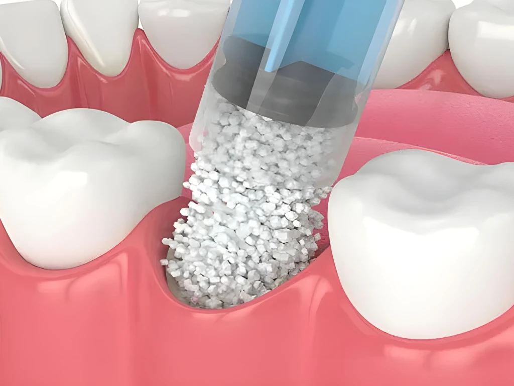 پودر استخوان دندانپزشکی