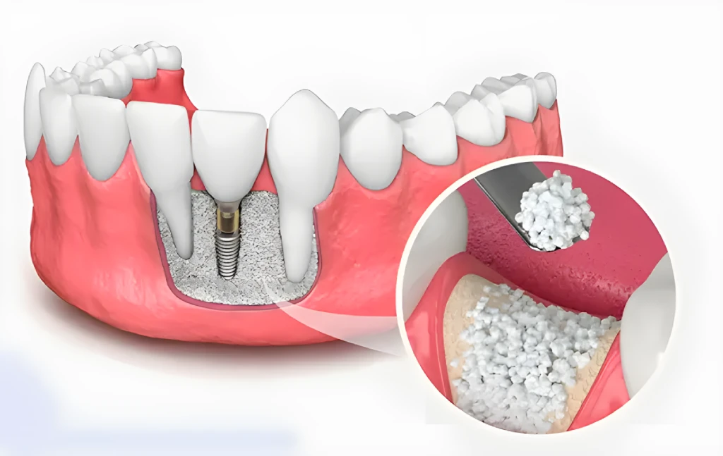 پودر استخوان دندانپزشکی