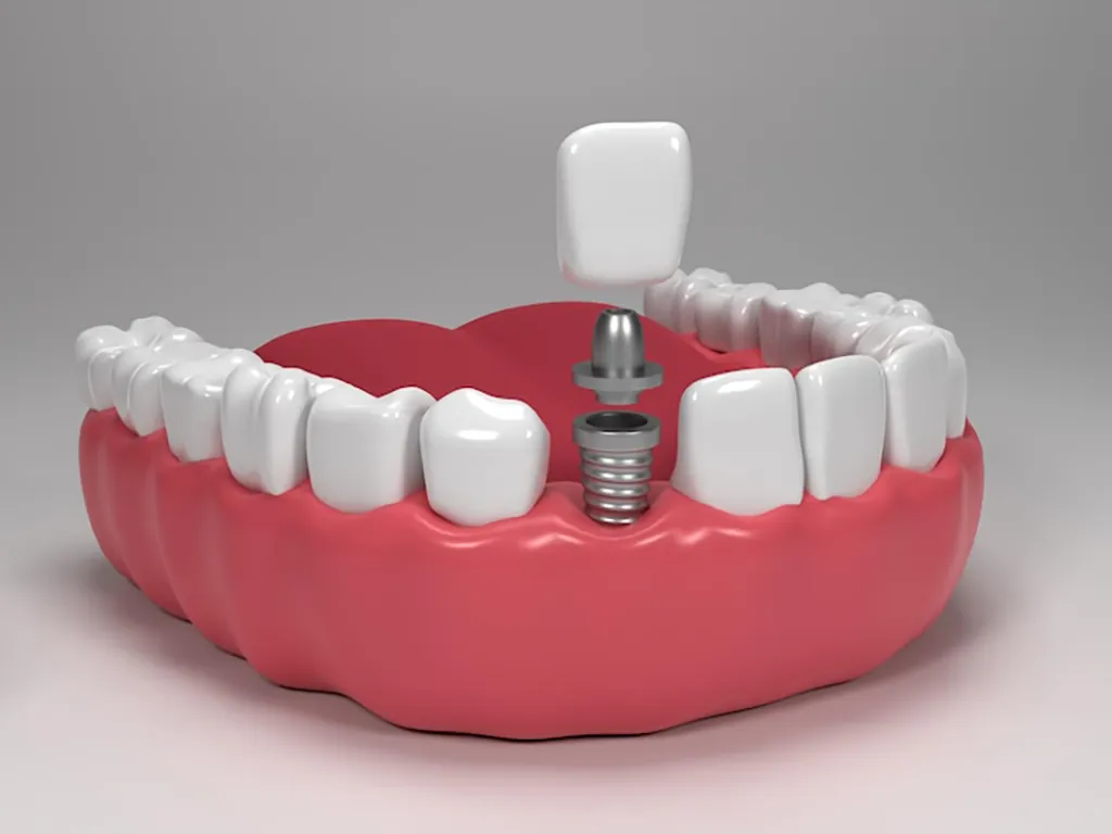 خرید ایمپلنت دندان کره ای