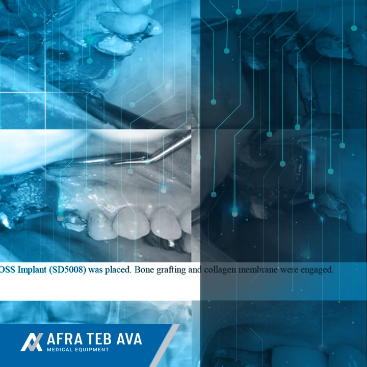 Clinical Cases Sterioss Implant Early Prosthetic Loading