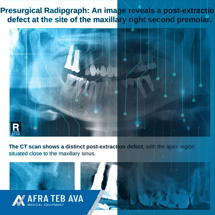long term stability ti oss radio opacity 60 months