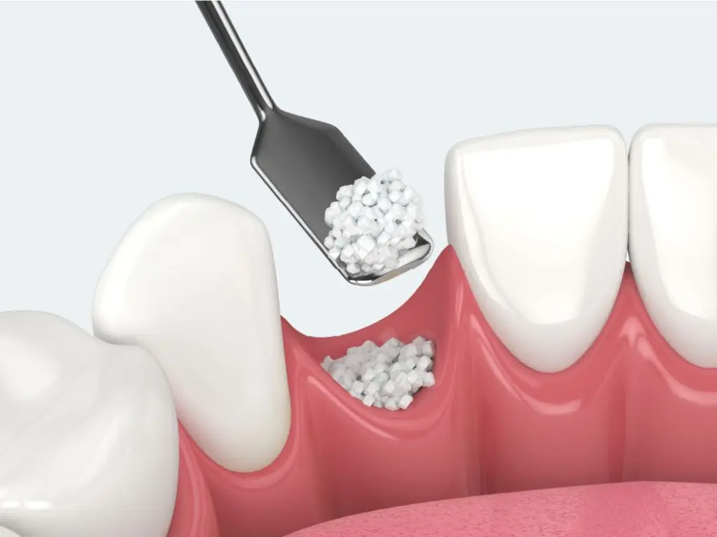 dental bone graft