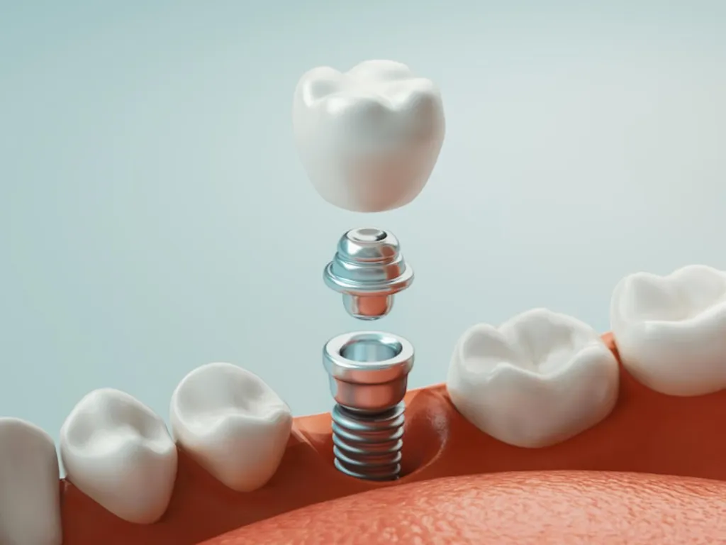 dental implant components