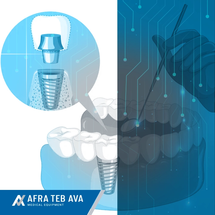 dental implant infographic 1