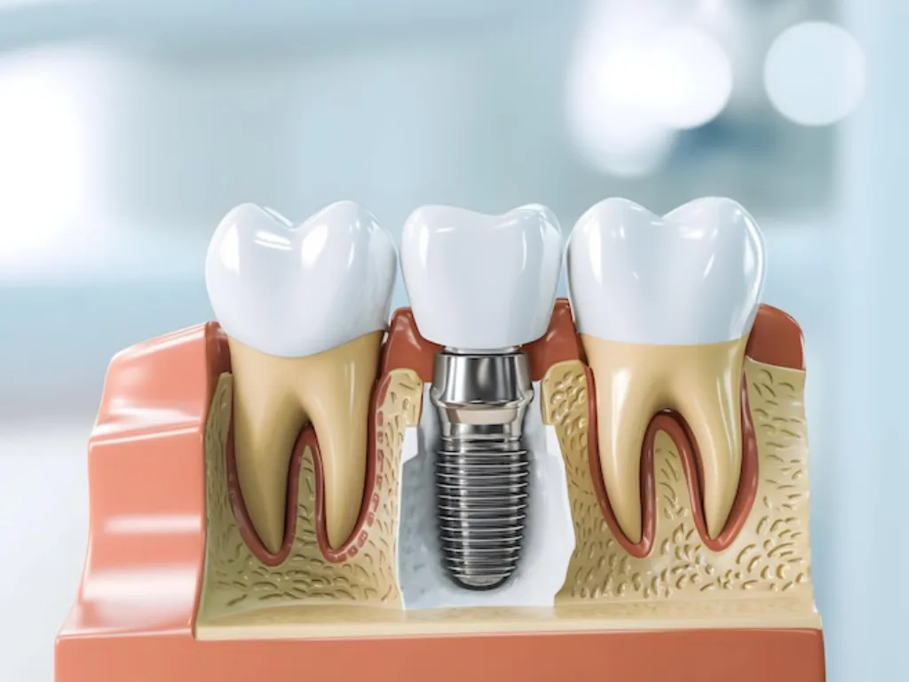 dental implant model